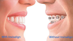 Invisalign at Energetic Smile in Brea