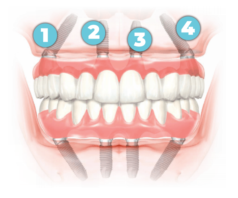 The All-on-Four Denture Solution